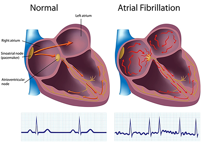 Illustrations of normal heart versus one with AFib.