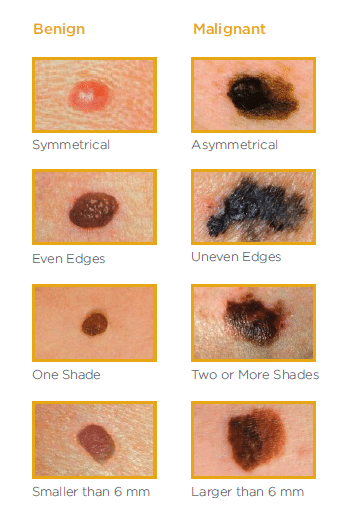 Differences between benign and malignant moles