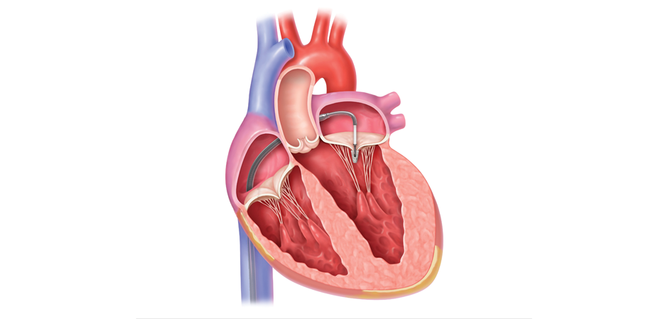 MitraClip Post Procedure Graphic