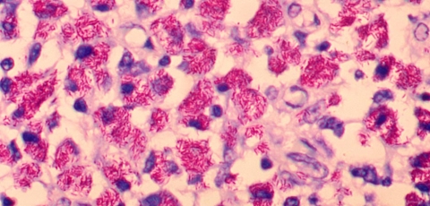 Mycobacterium avium complex lung disease