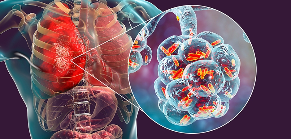 Nontuberculous mycobacteria lung disease