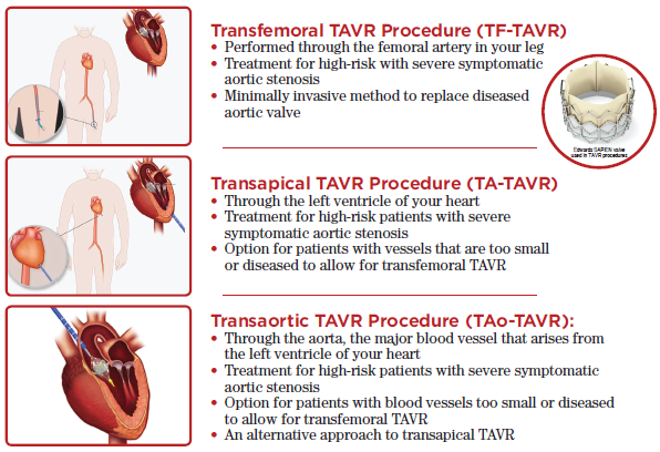 how long does a tavr procedure last